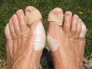 como curar rapido las ampollas de los pies